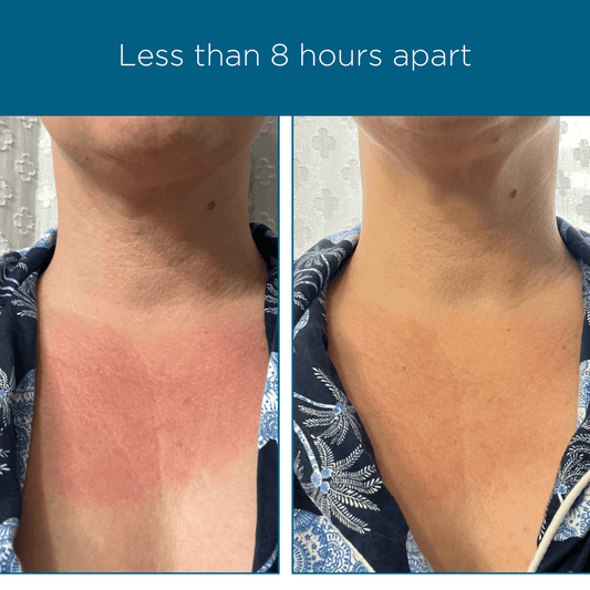 The Silent Sunburn: Understanding UV Radiation's Impact on the Skin Microbiome - LaFlorePRO