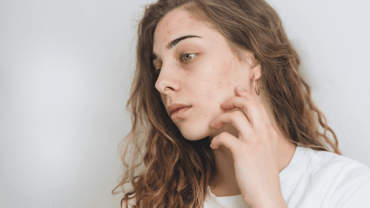 The Surprising Link Between Acne, Stress, and The Skin's Tiny Inhabitants - LaFlorePRO